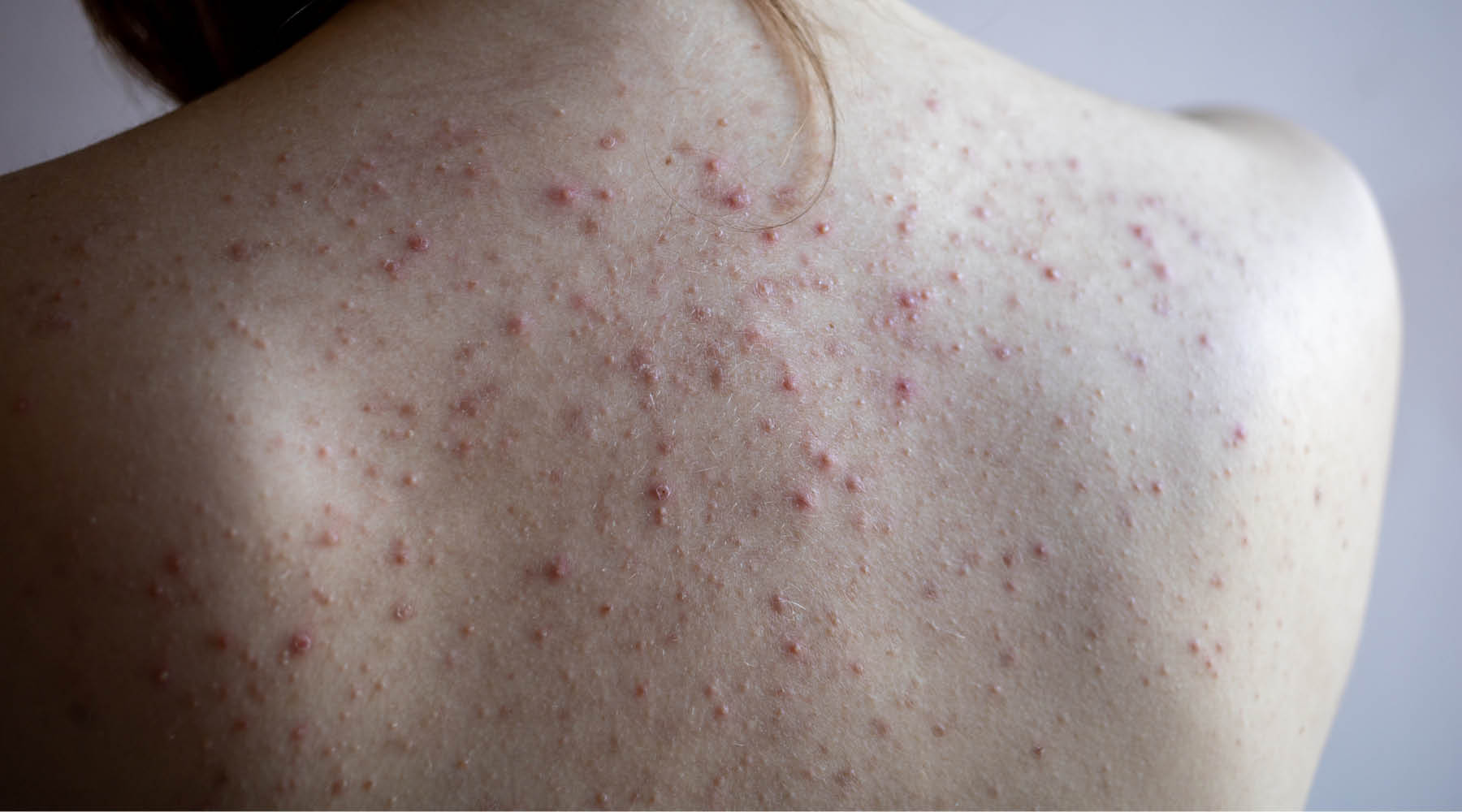 Got Back Acne? Here's How to Actually Get Rid of It