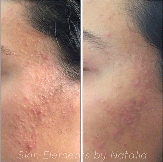 Eruption Emulsion