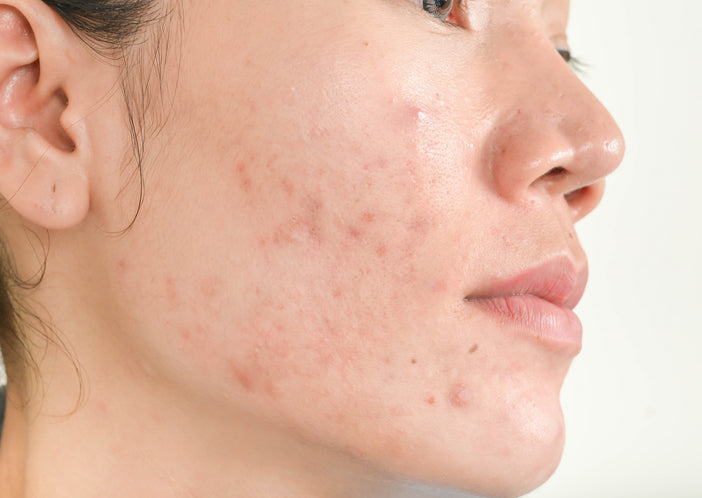 The Comedogenic Myth: Why Avoiding Certain Ingredients Isn’t a Cure-All for Acne