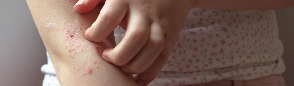 Effective Eczema Treatment: A Comprehensive Guide to Managing Your Symptoms