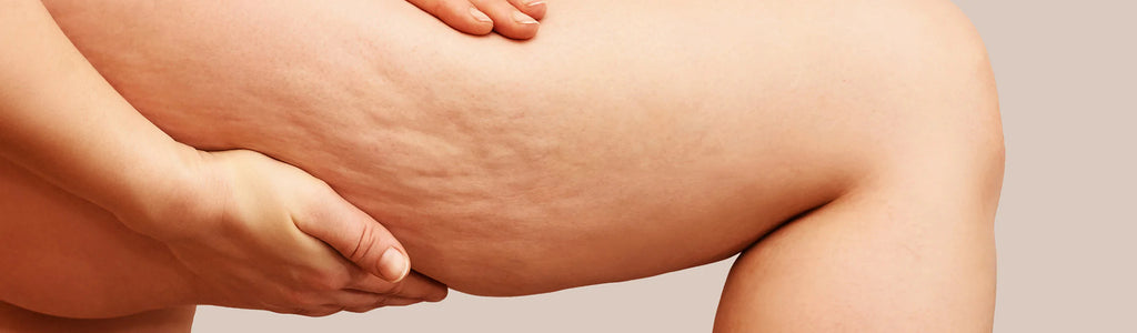 7 Hard Truths About Cellulite – Cellulite Facts & Treatment