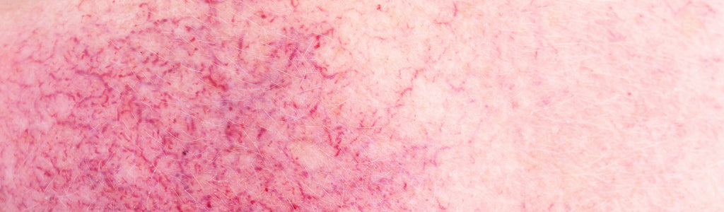 Rosacea: The Common Skin Condition You Need to Know About