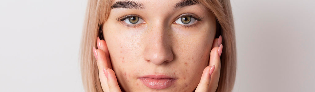 The Importance of Sunscreen for Acne-Prone Skin: What to Look for in a Safe and Effective Product