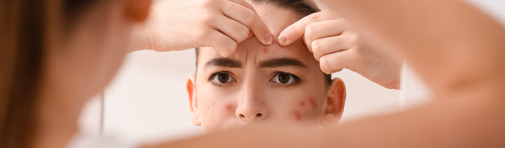 What Causes Acne and How to Deal with It?