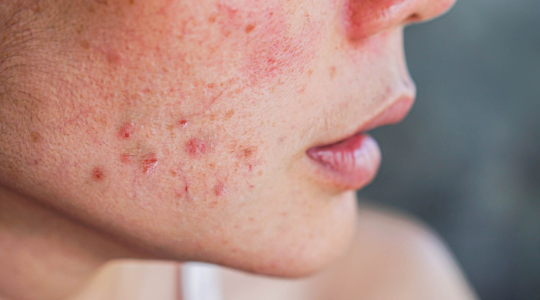 Supplements to Help Clear Acne-Prone Skin: Nature's Secret Weapons