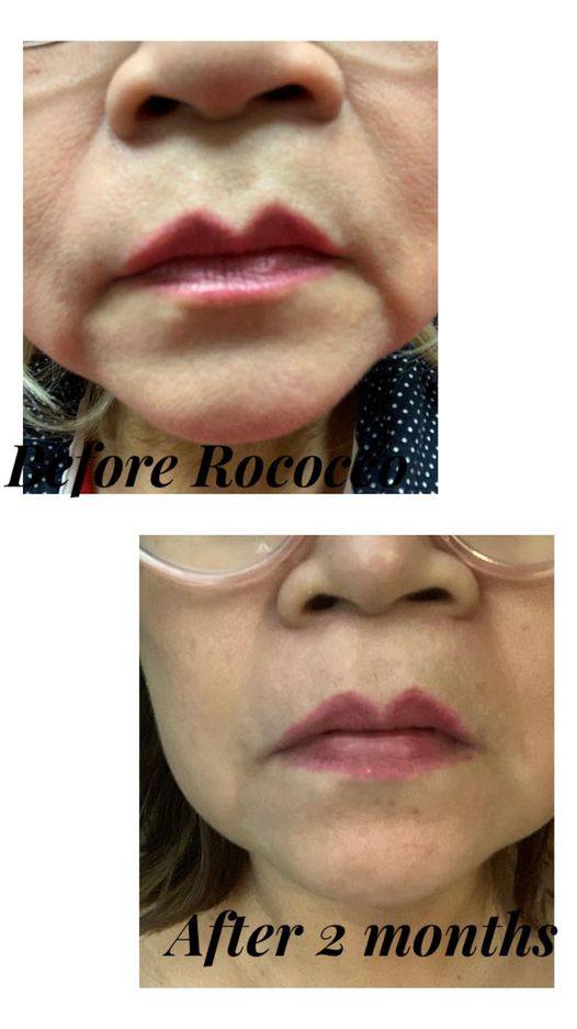 LRT Lift + Rejuvenate + Tone