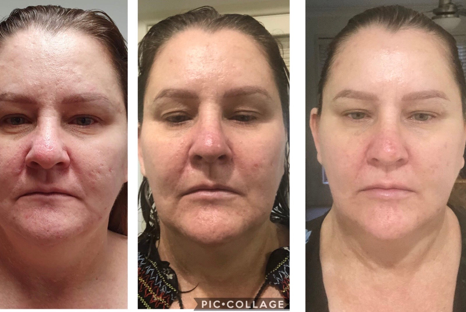 LRT Lift + Rejuvenate + Tone