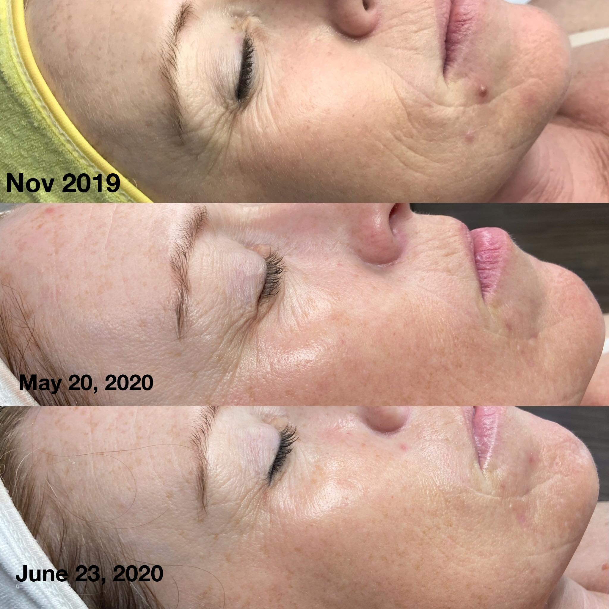 LRT Lift + Rejuvenate + Tone